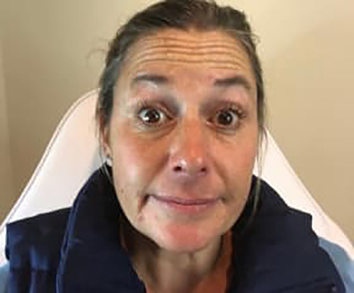 Before Image: Botox - front