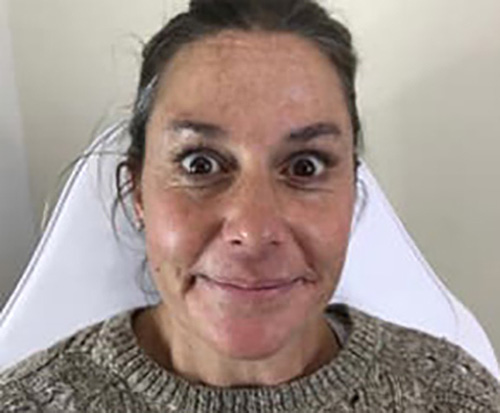 After Image: Botox - front