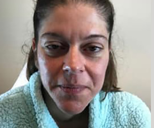 Before Image: Dermal Filler - front