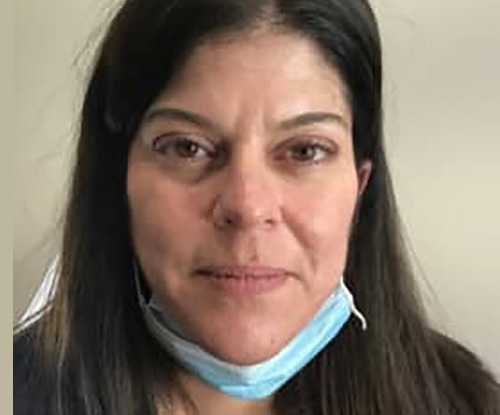 After Image: Dermal Filler - front