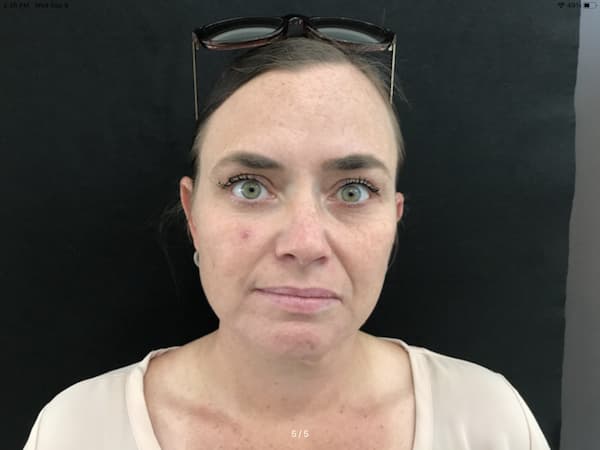 After Image: Botox - front