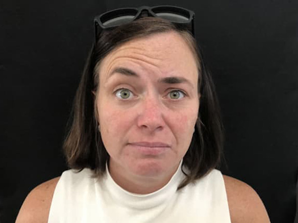Before Image: Botox - front