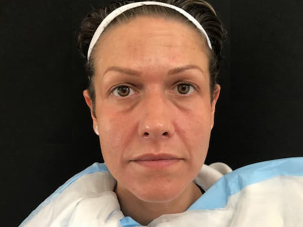 After Image: Botox - front