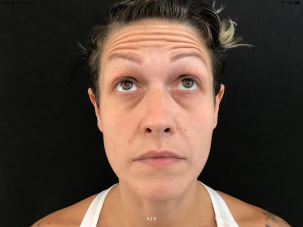 Before Image: Botox - front