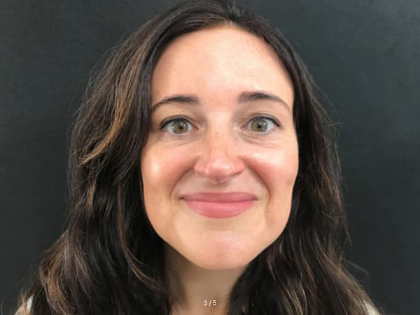 After Image: Botox - front