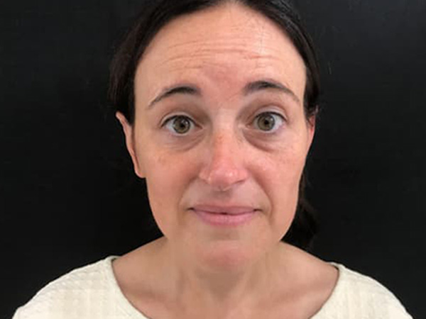 Before Image: Botox - front
