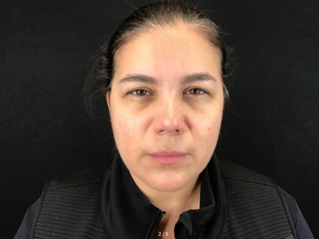 After Image: Botox - front