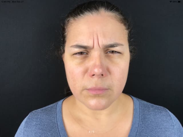 Before Image: Botox - front