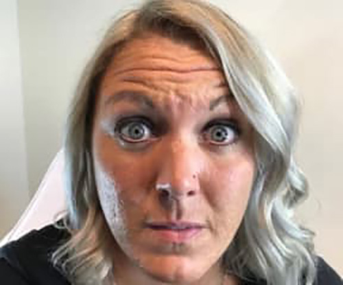 Before Image: Botox - front