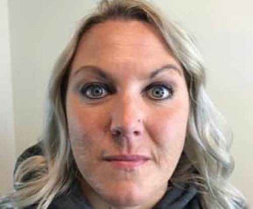 After Image: Botox - front