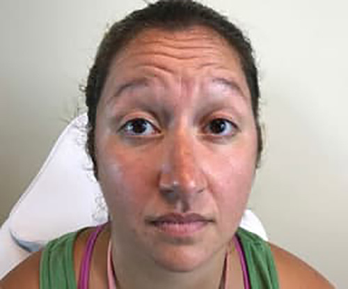 Before Image: Botox - front