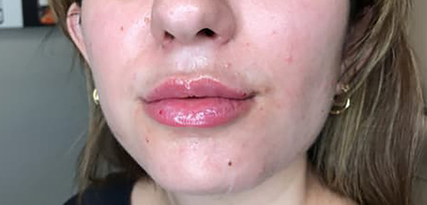 After Image: Dermal Filler - front