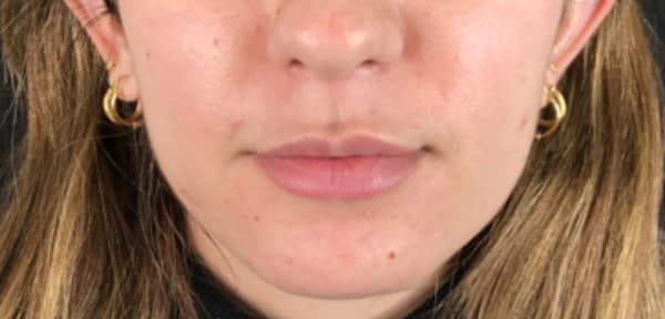 Before Image: Dermal Filler - front