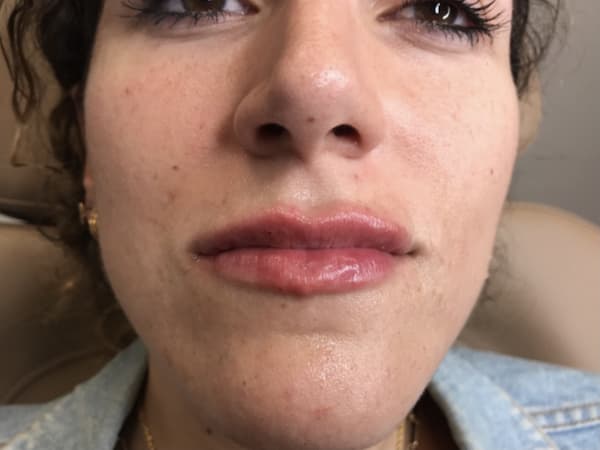 After Image: Dermal Filler - front