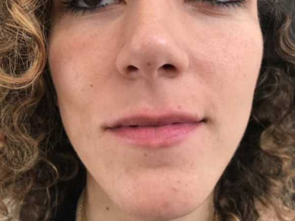 Before Image: Dermal Filler - front