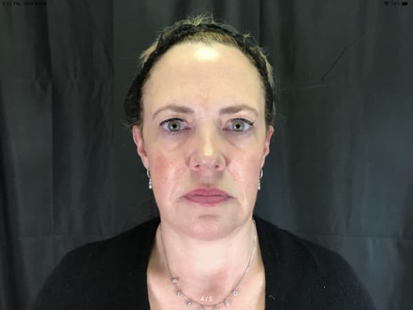 After Image: Dermal Filler - front