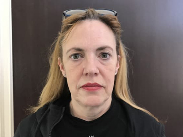 Before Image: Dermal Filler - front