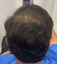 After Image: Hair Restoration - back