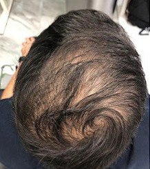 Before Image: Hair Restoration - back