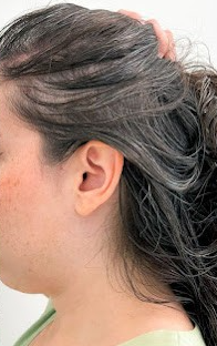 After Image: Hair Restoration - left-side
