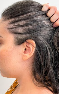 Before Image: Hair Restoration - left-side
