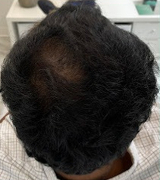 After Image: Hair Restoration - back