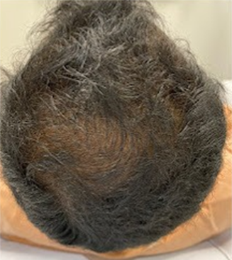 Before Image: Hair Restoration - back