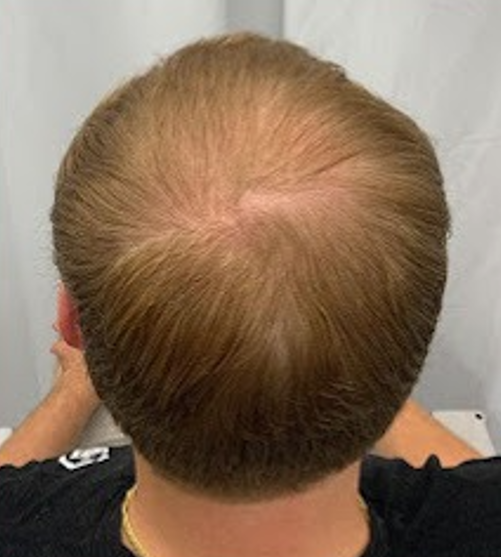 After Image: Hair Restoration - back