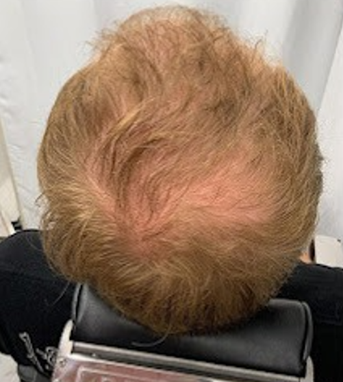 Before Image: Hair Restoration - back