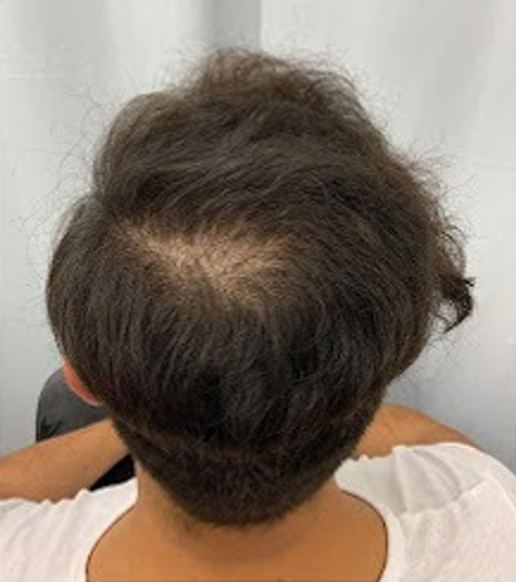 Before Image: Hair Restoration - back