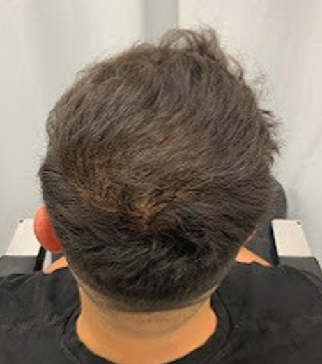After Image: Hair Restoration - back