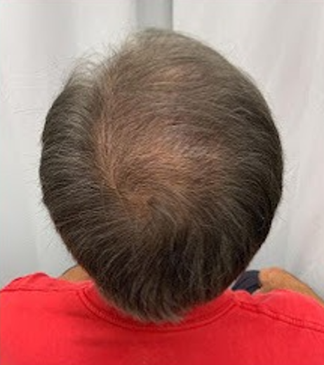 After Image: Hair Restoration - back