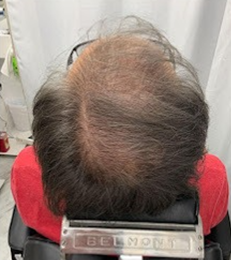 Before Image: Hair Restoration - back