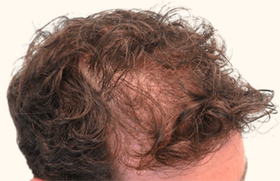 Before Image: Hair Restoration - right-front-oblique