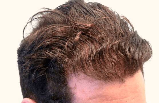 After Image: Hair Restoration - right-front-oblique