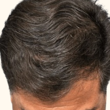 After Image: Hair Restoration - front