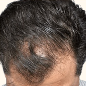 Before Image: Hair Restoration - front