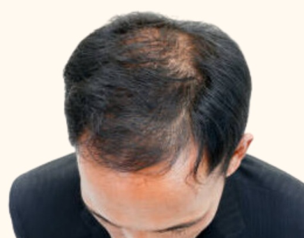 Before Image: Hair Restoration - front