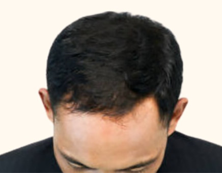 After Image: Hair Restoration - front