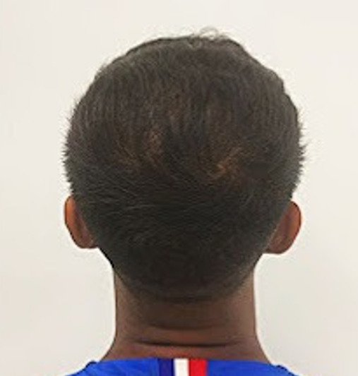 After Image: Hair Restoration - back
