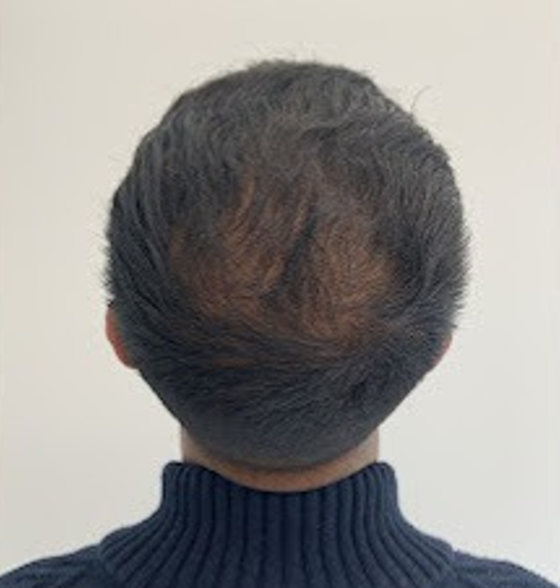 Before Image: Hair Restoration - back