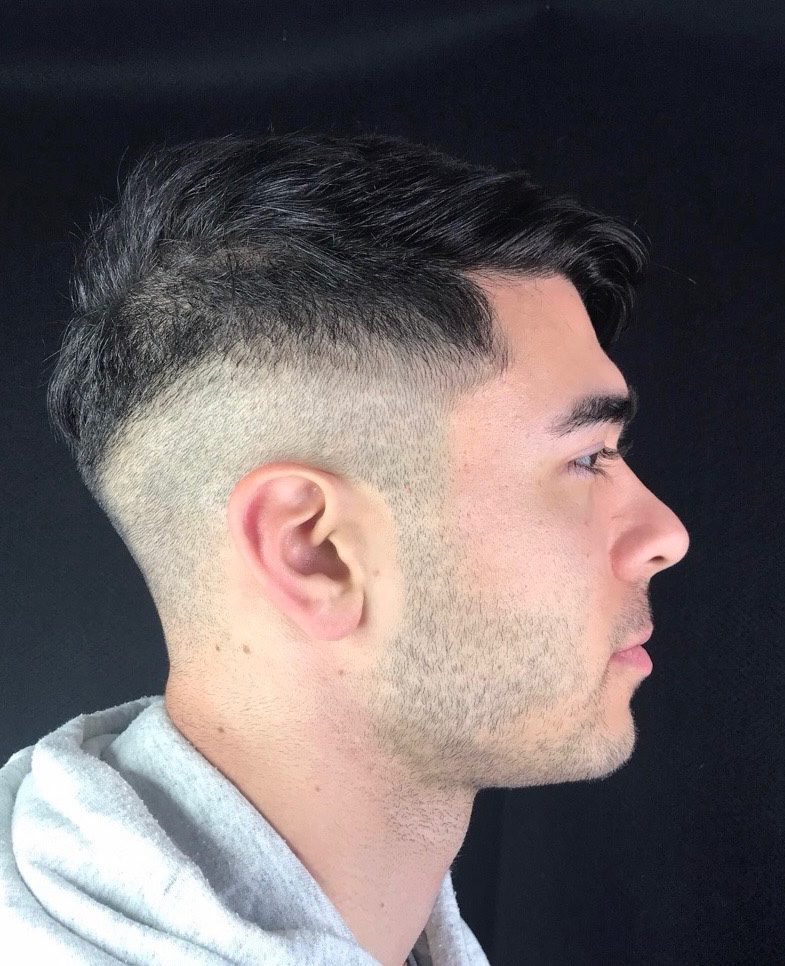 After Image: Hair Restoration - right-side