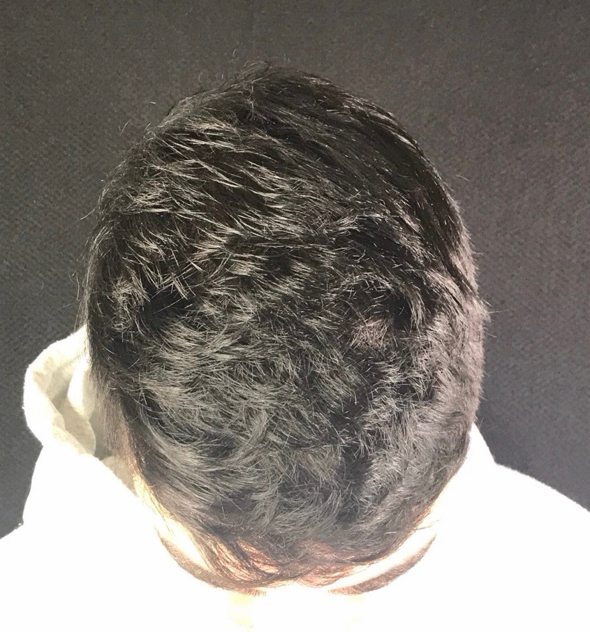 After Image: Hair Restoration - front