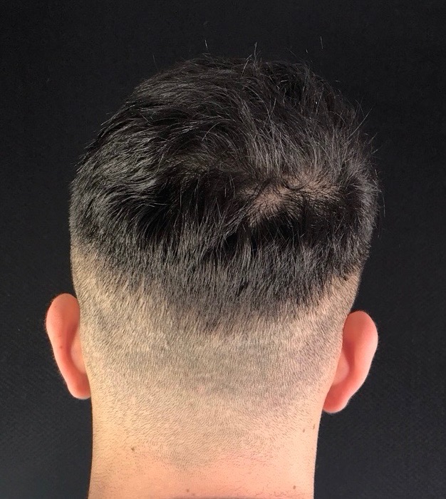 After Image: Hair Restoration - back