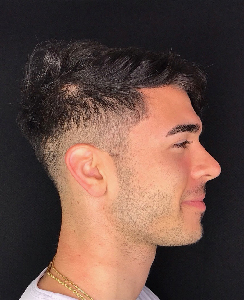 Before Image: Hair Restoration - right-side