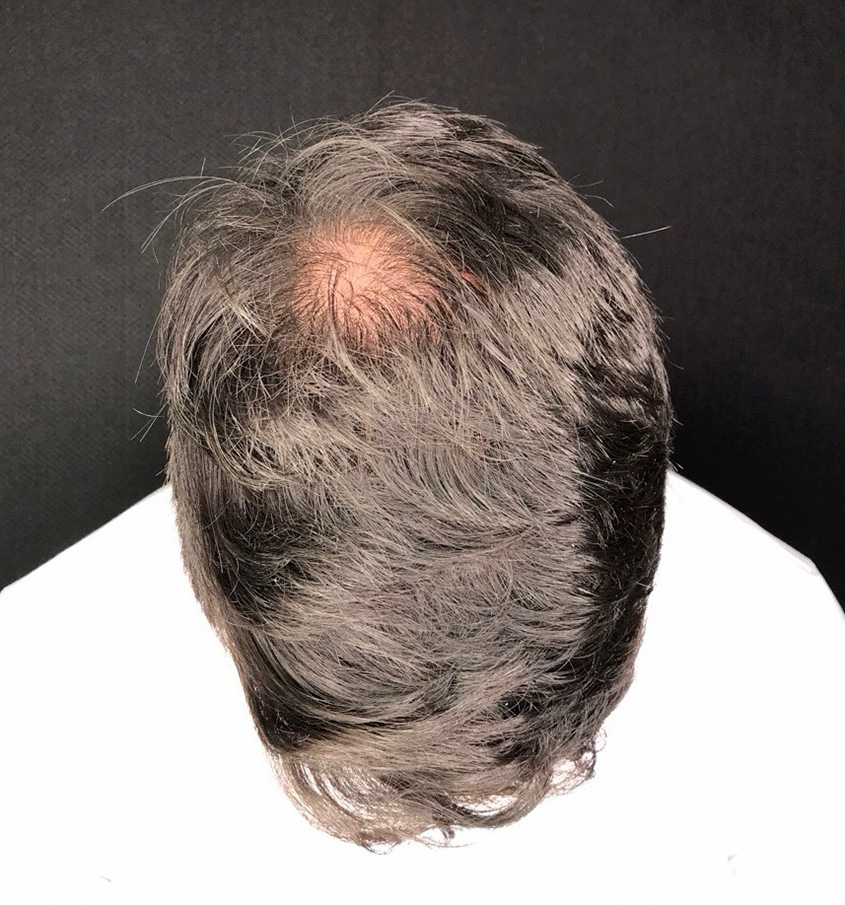 Before Image: Hair Restoration - front