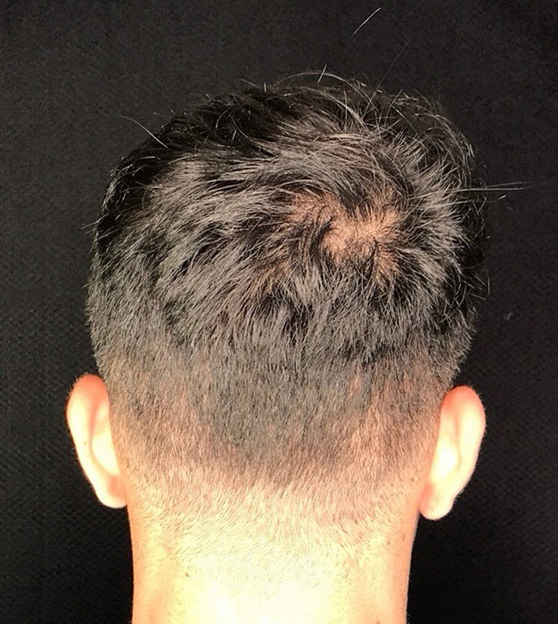 Before Image: Hair Restoration - back