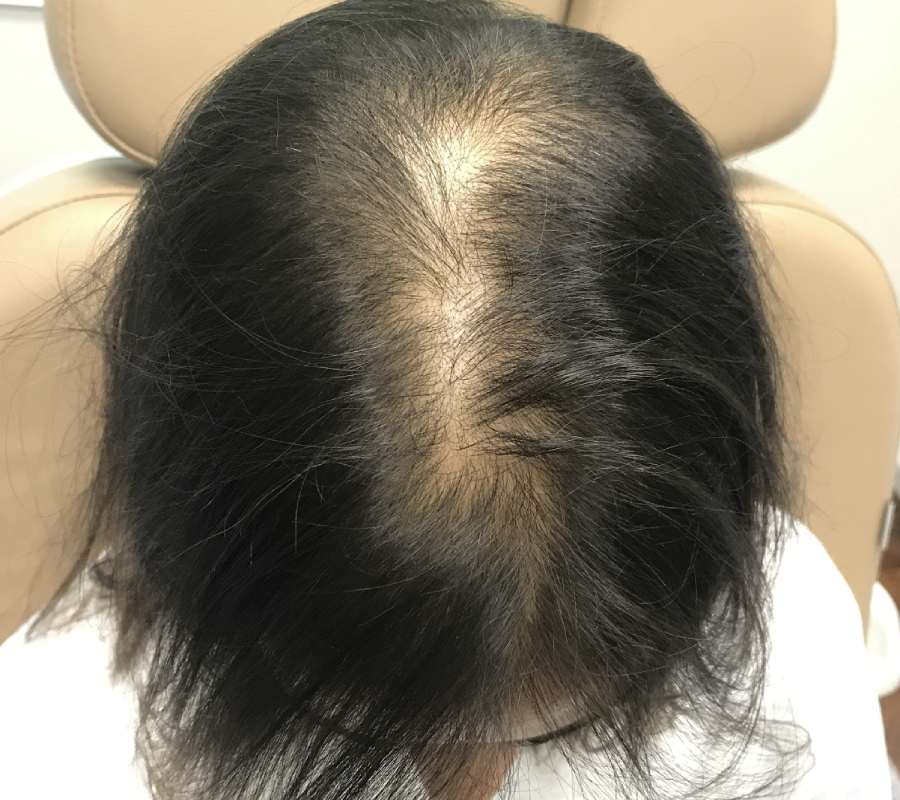 After Image: Hair Restoration - back
