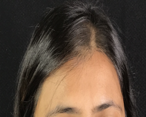 After Image: Hair Restoration - front