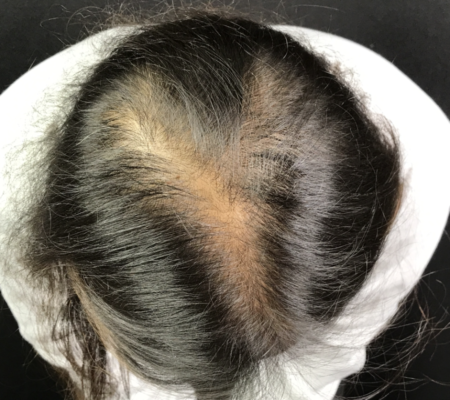 Before Image: Hair Restoration - back